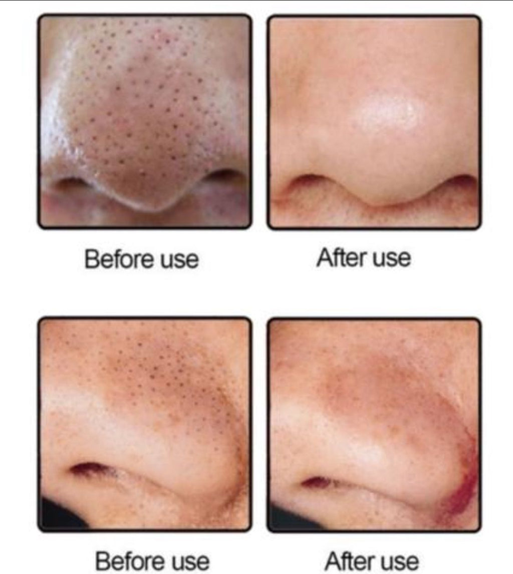 GlowVac — Deep Pore & Blackhead Remover
